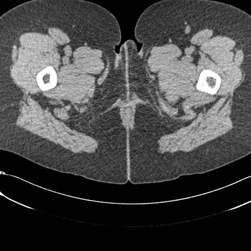 Bilateral acetabular protrusion with pincer type femoro-acetabular impingement (Radiopaedia 30134-30733 AXIAL SOFT THIN 121).jpg