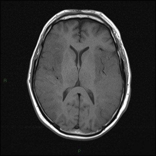 File:Bilateral acute middle cerebral artery territory infarcts (Radiopaedia 77319-89402 Axial T1 13).jpg