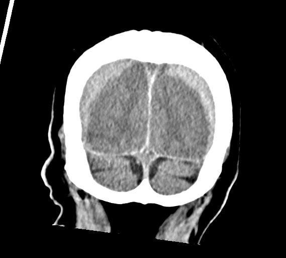 Bilateral acute on chronic subdural hematomas (Radiopaedia 78466-91146 Coronal non-contrast 59).jpg