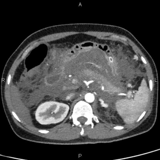 Bilateral adrenal gland hyperenhancement in pancreatitis (Radiopaedia 86642-102753 B 41).jpg