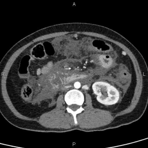 Bilateral adrenal gland hyperenhancement in pancreatitis (Radiopaedia 86642-102753 B 70).jpg