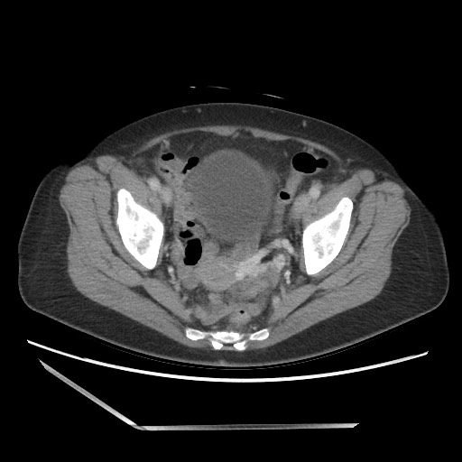 Bilateral adrenal granulocytic sarcomas (chloromas) (Radiopaedia 78375-91007 A 102).jpg