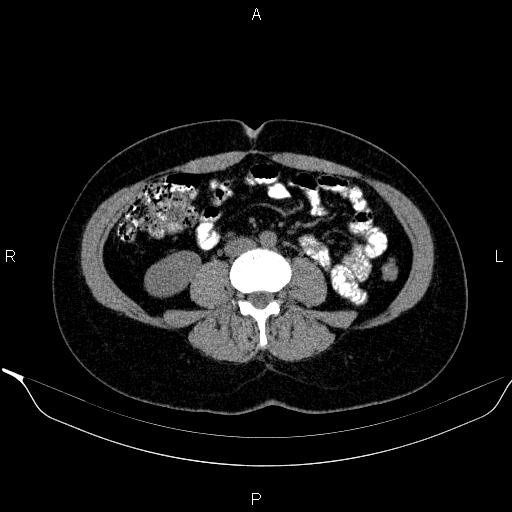 Bilateral adrenal myelolipoma (Radiopaedia 63058-71535 Axial non-contrast 100).jpg