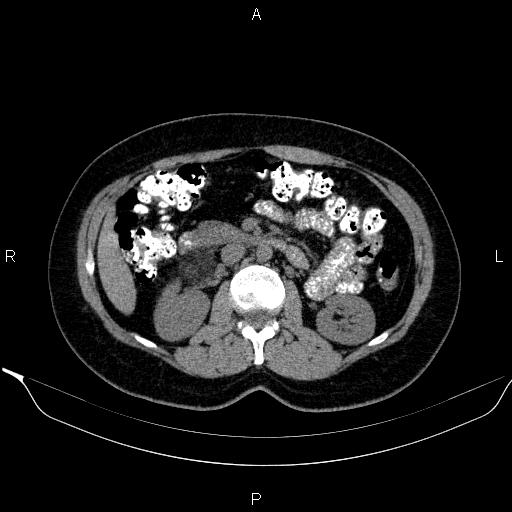 Bilateral adrenal myelolipoma (Radiopaedia 63058-71535 Axial non-contrast 73).jpg