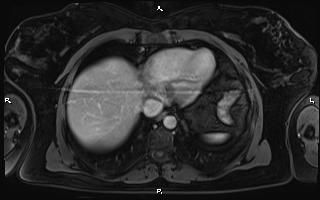 Bilateral adrenal myelolipoma (Radiopaedia 63058-71537 G 12).jpg