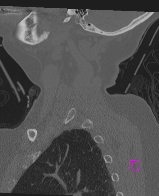 Bilateral atlanto-occipital assimilation (Radiopaedia 28350-28603 Sagittal bone window 13).jpg
