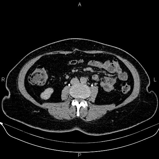File:Bilateral benign adrenal adenomas (Radiopaedia 86912-103124 Axial C+ delayed 85).jpg