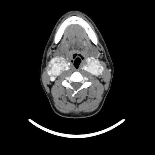 Bilateral carotid body tumors (Radiopaedia 52899-58827 A 13).jpg