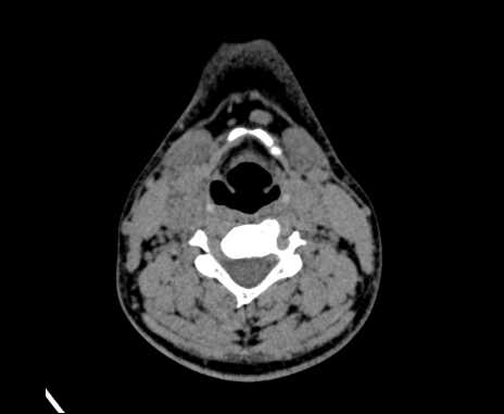 Bilateral carotid body tumors (Radiopaedia 61841-69870 Axial non-contrast 59).jpg