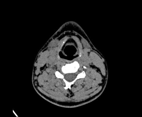 Bilateral carotid body tumors (Radiopaedia 61841-69870 Axial non-contrast 62).jpg