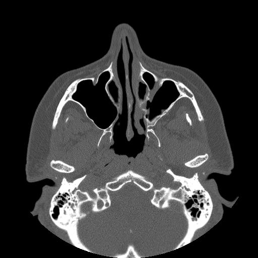 File:Bilateral ectopic infraorbital nerves (Radiopaedia 49006-54084 Axial 5).jpg