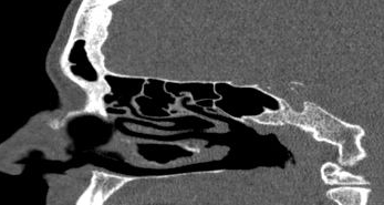 File:Bilateral ectopic infraorbital nerves (Radiopaedia 49006-54084 Sagittal 10).png
