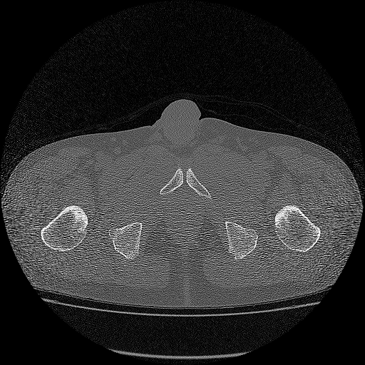 Bilateral femoral neck stress fractures (Radiopaedia 28666-28954 Axial bone window 73).png