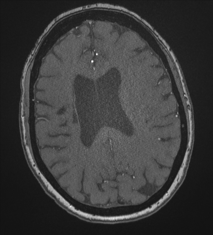 Bilateral fetal posterior communicating arteries (Radiopaedia 41286-44102 Axial MRA 145).png