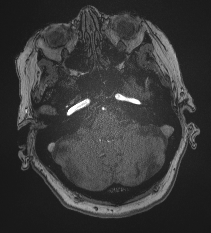 Bilateral fetal posterior communicating arteries (Radiopaedia 41286-44102 Axial MRA 34).png