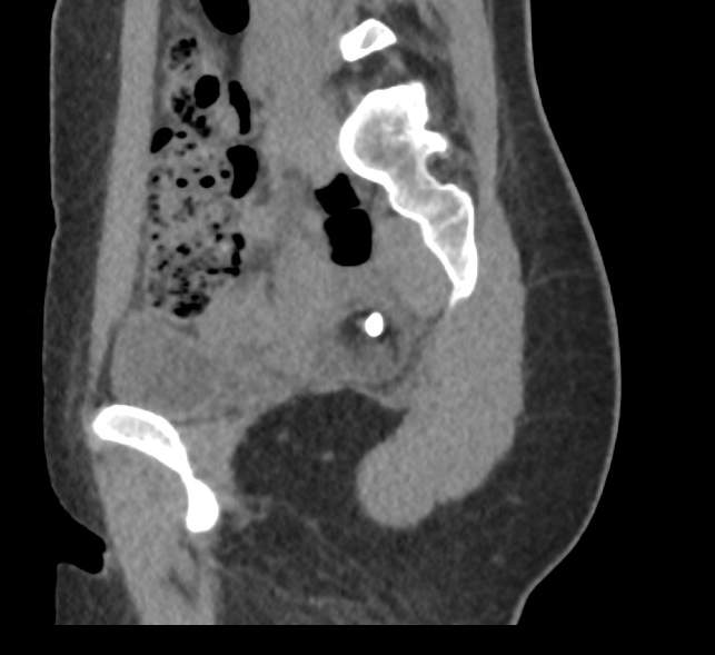 Bilateral mature cystic ovarian teratoma (Radiopaedia 88821-105592 D 17).jpg