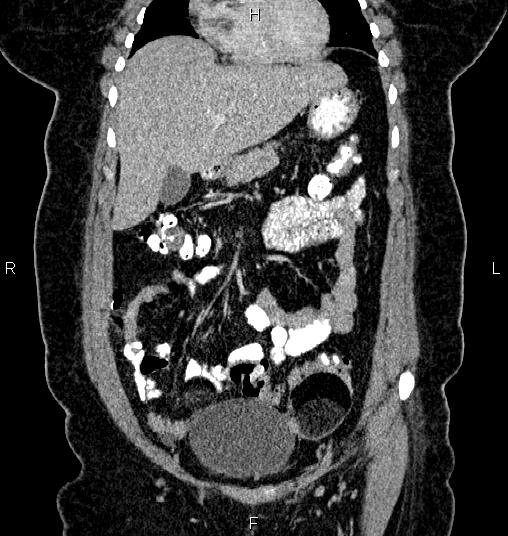 Bilateral ovarian dermoid cysts (Radiopaedia 85785-101603 C 13).jpg