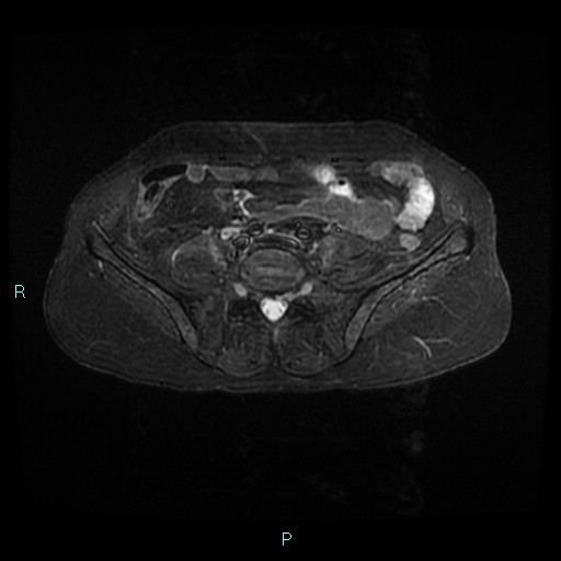 File:Bilateral ovarian fibroma (Radiopaedia 44568-48293 Axial STIR 1).jpg