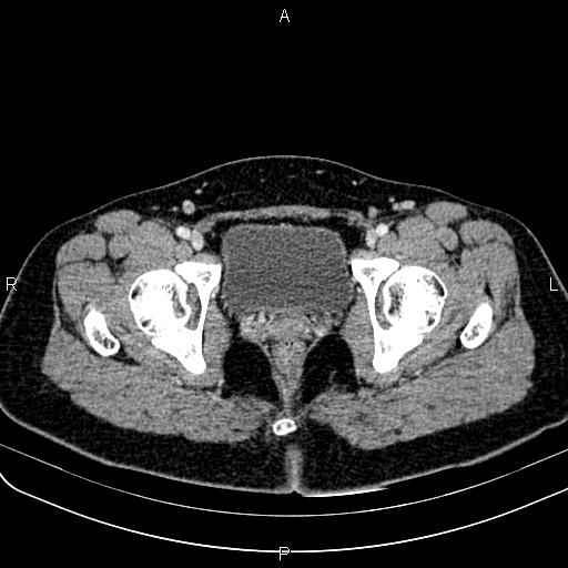 Bilateral ovarian teratoma (Radiopaedia 83131-97503 Axial With contrast 69).jpg
