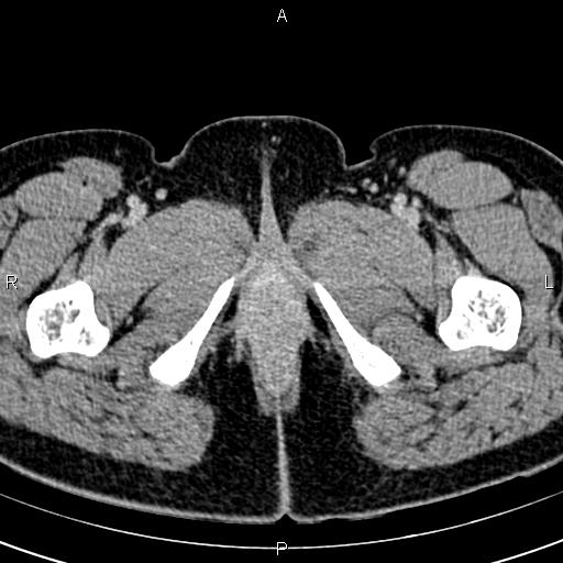 Bilateral ovarian teratoma (Radiopaedia 83131-97503 B 91).jpg