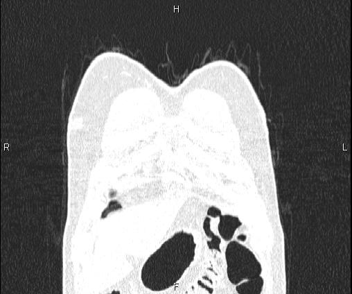 File:Bilateral pulmonary AVM (Radiopaedia 83134-97505 Coronal lung window 14).jpg