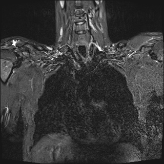 File:Bilateral spinoglenoid notch ganglion cysts (Radiopaedia 29577-30082 Coronal STIR 9).jpg