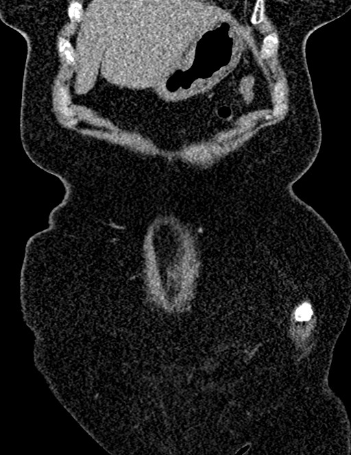 Bilateral staghorn calculi (Radiopaedia 59475-66842 Coronal non-contrast 37).jpg
