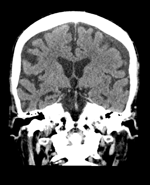 Bilateral subdural hygroma (Radiopaedia 73637-84421 Coronal non-contrast 24).jpg