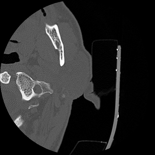 Bilateral temporal bone fractures (Radiopaedia 29482-29970 D 1).jpg