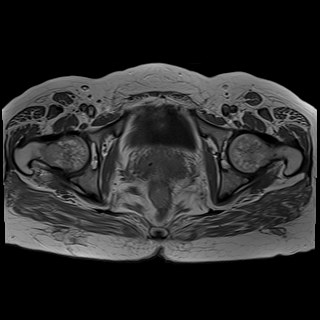 Bilateral tubo-ovarian abscesses (Radiopaedia 58635-65829 Axial T1 C+ 39).jpg