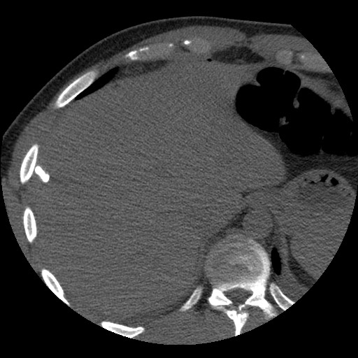 Bile leak from liver traumatic laceration (Radiopaedia 63463-72077 Axial Biliscopin 19).jpg