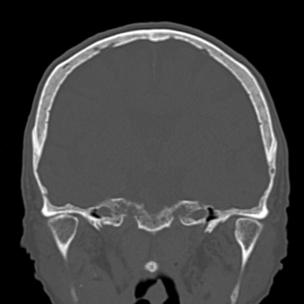 Biparietal osteodystrophy (Radiopaedia 46109-50463 Coronal bone window 55).jpg