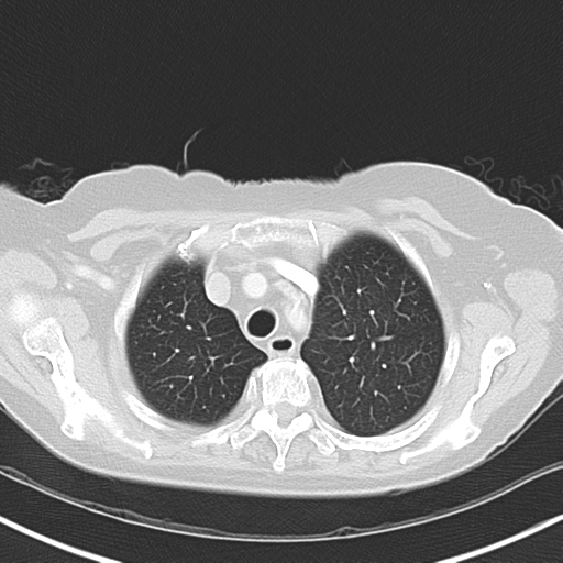 File:Bladder and bowel cancers (Radiopaedia 37688-39592 Axial lung window 11).png