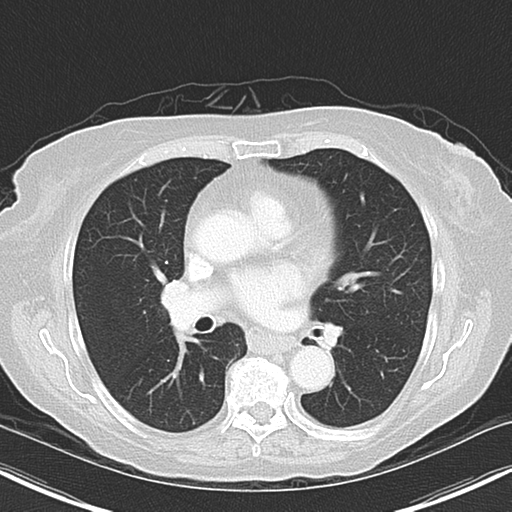 File:Bladder and bowel cancers (Radiopaedia 37688-39592 Axial lung window 28).png