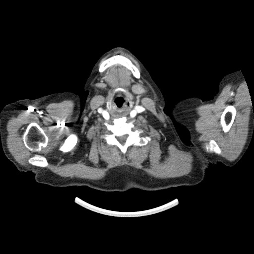 Bladder tumor detected on trauma CT (Radiopaedia 51809-57609 A 4).jpg