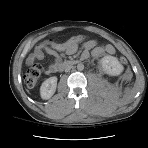 Blunt abdominal trauma with solid organ and musculoskelatal injury with active extravasation (Radiopaedia 68364-77895 Axial C+ delayed 63).jpg