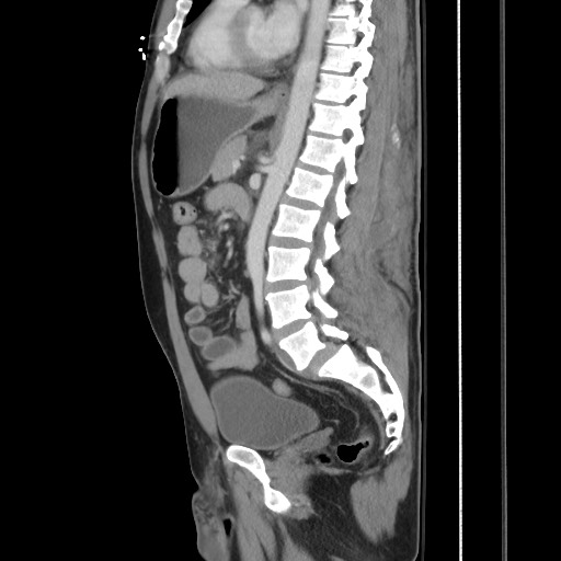 Blunt abdominal trauma with solid organ and musculoskelatal injury with active extravasation (Radiopaedia 68364-77895 C 82).jpg