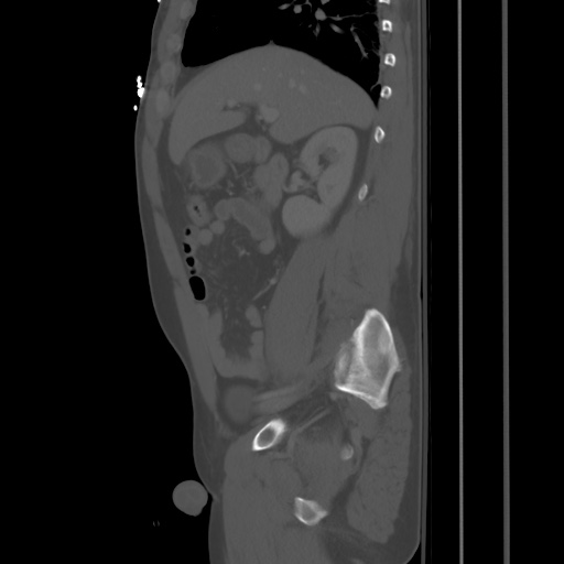 Blunt abdominal trauma with solid organ and musculoskelatal injury with active extravasation (Radiopaedia 68364-77895 Sagittal bone window 32).jpg