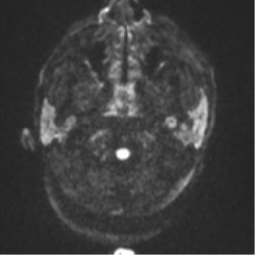 Blunt cerebrovascular injury (Radiopaedia 53682-59745 Axial DWI 32).png