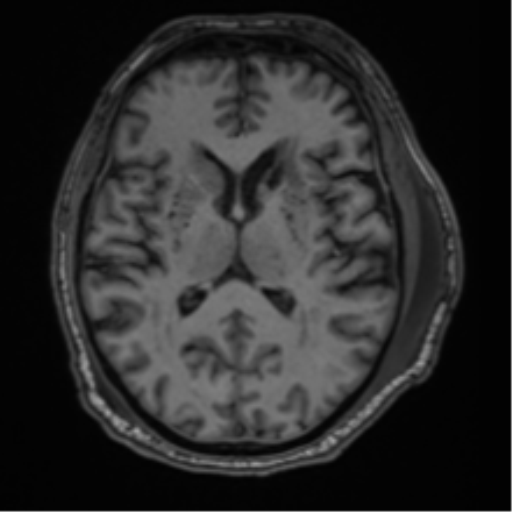 File:Blunt cerebrovascular injury (Radiopaedia 53682-59745 Axial T1 18).png