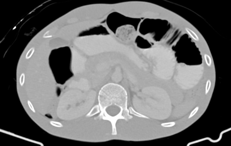 Blunt injury to the small bowel (Radiopaedia 74953-85987 Axial Wide 23).jpg