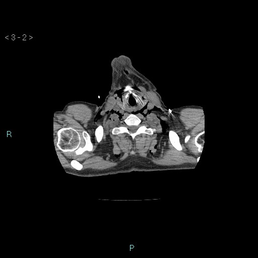 Boerhaave syndrome (Radiopaedia 27683-27897 Axial non-contrast 2).jpg