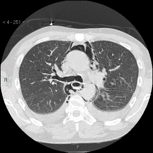 Boerhaave syndrome (Radiopaedia 27683-27897 lung window 12).jpg