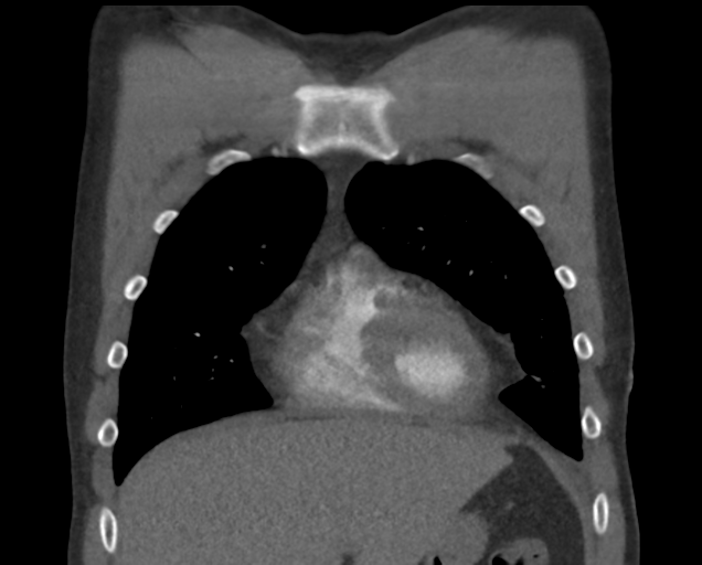 Boerhaave syndrome (Radiopaedia 39382-41660 C 24).png