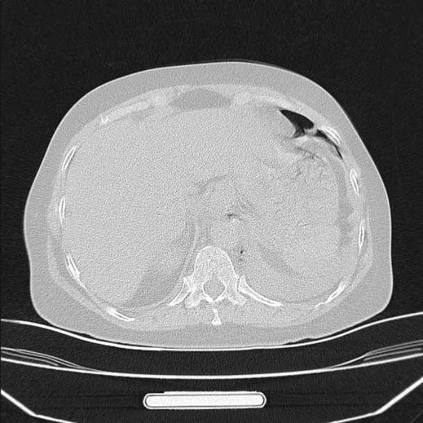 Boerhaave syndrome (Radiopaedia 45644-49799 Axial lung window 97).jpg