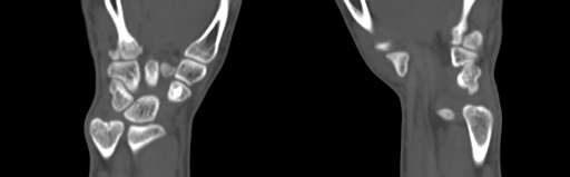 Bone islands - carpus (Radiopaedia 63141-71658 Coronal bone window 50).jpg