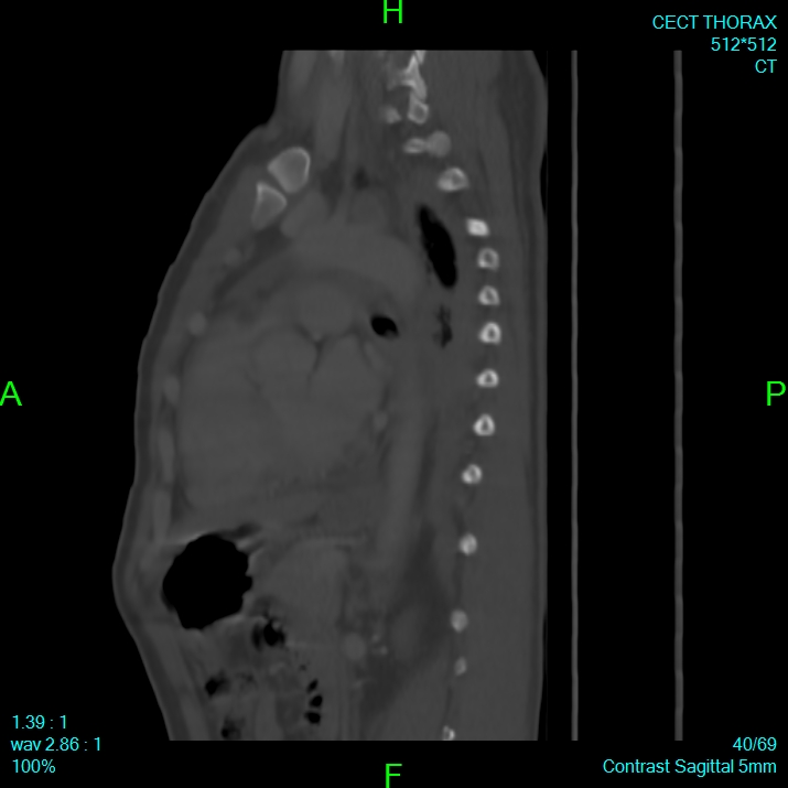 Bone metastases from lung carcinoma (Radiopaedia 54703-60937 Sagittal bone window 40).jpg