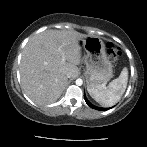 File:Borderline mucinous tumor (ovary) (Radiopaedia 78228-90808 A 42).jpg