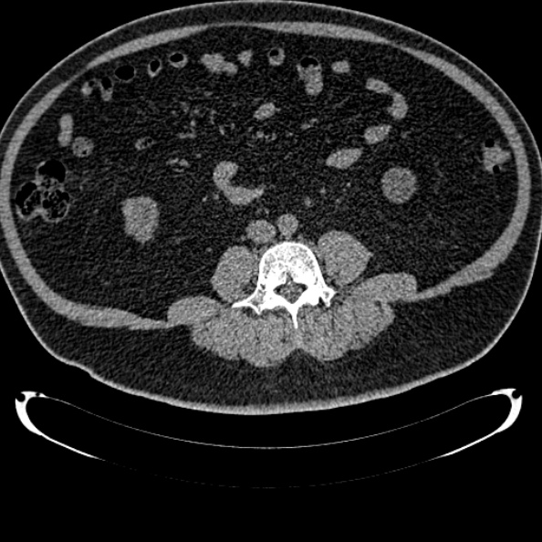 File:Bosniak renal cyst - type IV (Radiopaedia 24244-24518 Axial non-contrast 200).jpg