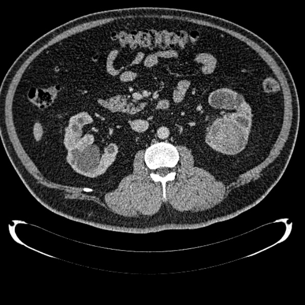 File:Bosniak renal cyst - type IV (Radiopaedia 24244-24518 C 161).jpg